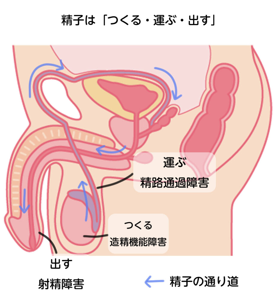 精子の通り道と、つくる(造精機能障害)・運ぶ(精路通過障害)・出す(射精障害)の3つの原因の場所を示した図